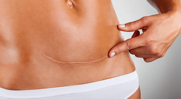 Mujer mostrando una cicatriz en el abdomen después de tratamiento de cicatrices en Barcelona con camuflaje estético natural