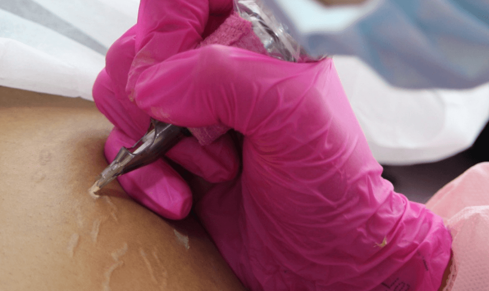 tratamiento de camuflaje en Barcelona