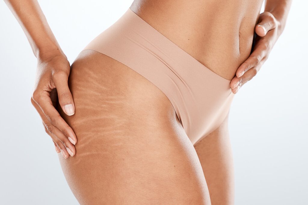 eliminar estrías en Barcelona